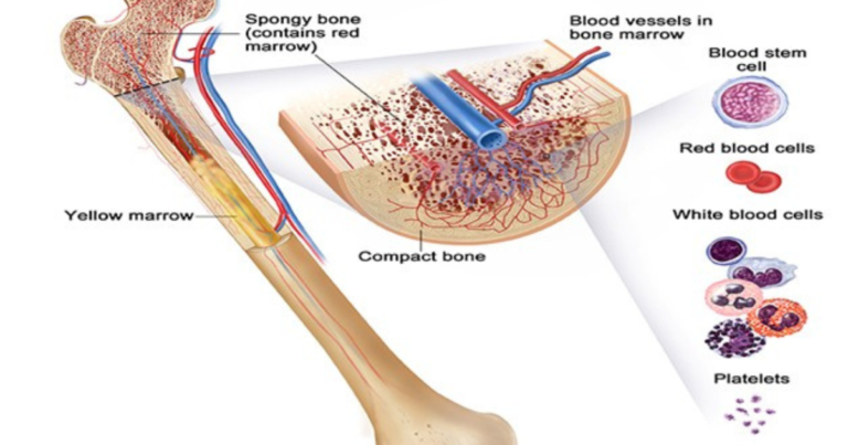 Bone Marrow Leukemia Treatment with DXN Herbal Products